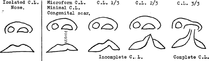 5 diagrams of the Onizuka classification. The isolated C L nose, microform C L minimal C L congenital scar, incomplete C L 1 over 3, 2 over 3, and complete C L 3 over 3 are illustrated.