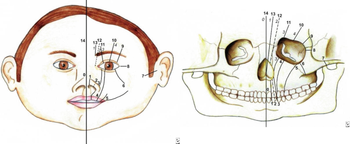 Two illustrations of Tessier cleft zones and individual cleft zones a. The skull bones of prosomeric, mesomeric, and rhombomeric are depicted. b. The medial, lateral nasopalatine, descending palatine, medial, lateral, superior infraorbital, zygomaticofacial, and zygomaticotemporal axis are displayed and numbered.