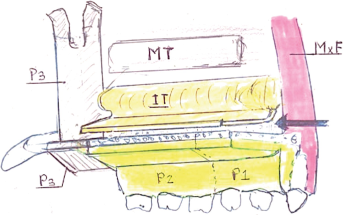 A diagram of nasal floor closure. The M T, I T, P 1 to P 3, and M x F are indicated.