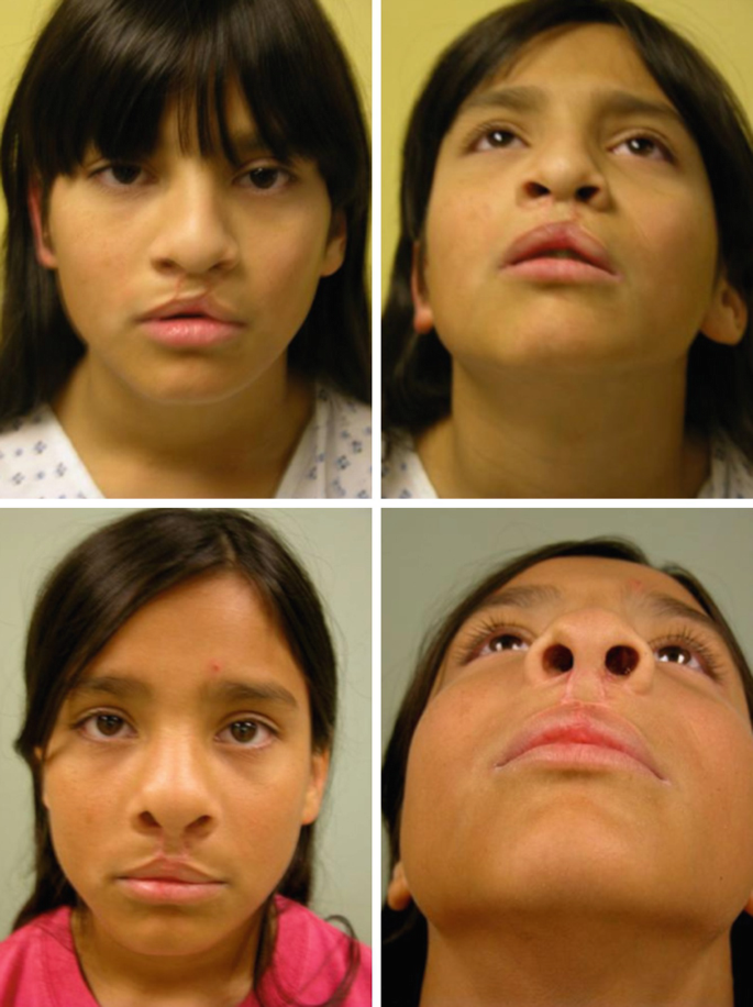 Four photographs of nasal airway restoration. The typical compression of the nose and nasal airway is at the top, and the functional and esthetic improvement after is at the bottom.