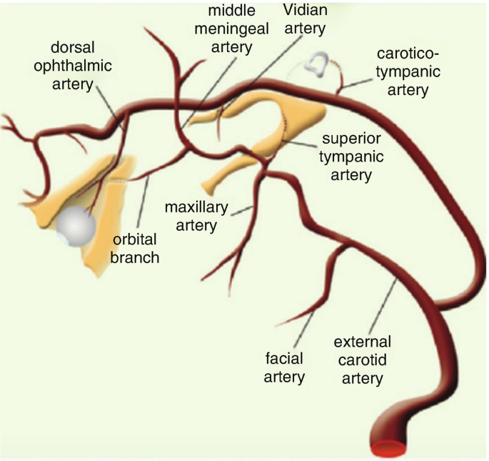 A vasculature diagram has a dorsal ophthalmic artery, middle meningeal artery, Vidian artery, carotico-tympanic artery, superior tympanic artery, maxillary artery, orbital branch, external carotid artery, and facial artery.