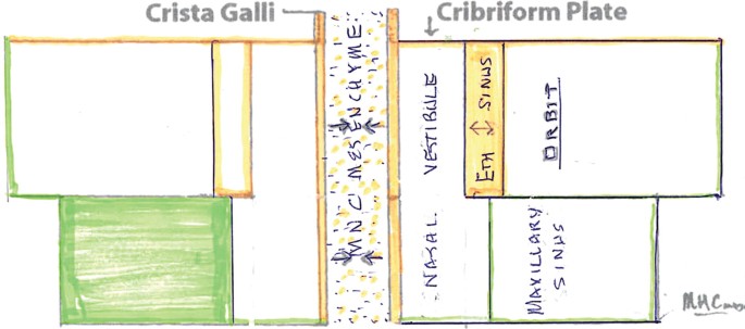 A box diagram. MNC mesenchyme in the center is outlined by Crista Galli on the left and Cribriform plate on the right. The Cribriform plate has nasal and vestibular sections, then ethmoid sinus above followed by orbit. The maxillary sinus is below.