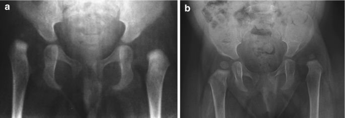 2 radiographs of the pelvic region of an infant exhibit the dislocation of the left hip with well-defined pelvic bones. It indicates the defects in the bony rim of the hip in a light shade.