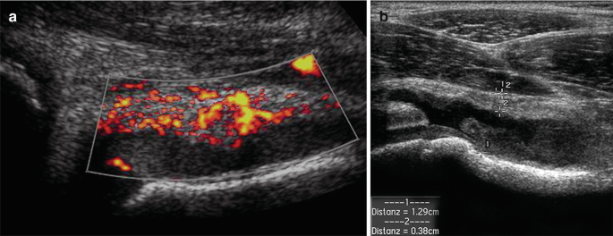 2 images. A. A power Doppler image of the hip with highlighted colored patches on the thickened synovium is denoted. B. An ultrasound image of the hip indicates the wavy patterns of echo-free fluid. It exhibits inflammation of the widened hip joint in a dark shade.