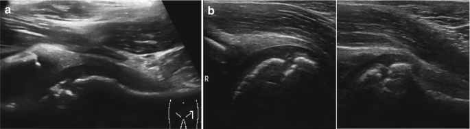 3 ultrasound images of the hip region in A and B indicate the wavy patterns of echo-free fluid. It exhibits disruption in the blood supply of the thigh bone, and dislocation of the widened joint is indicated in dark shades.