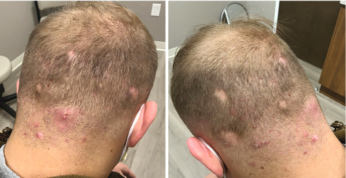 22-Year-Old Male with Firm, Itchy Papules, and Hair Loss on the Occipital  Scalp | SpringerLink