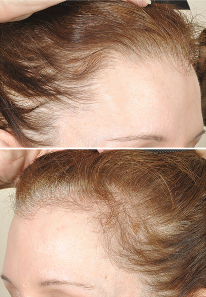 Hair Loss on Accutane and How to Prevent It