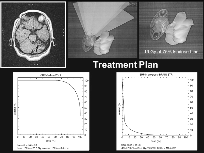 A C T scan illustrates a region of embolization in the left cerebellar hemisphere, two treatment plan layouts, and 2 volumes versus dose graphs of S R P 1 A V M V O I 2 and S R P in progress.