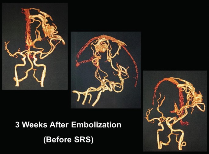 A 3-part brain scan of veins in the brain 3 weeks after embolization before S R S.