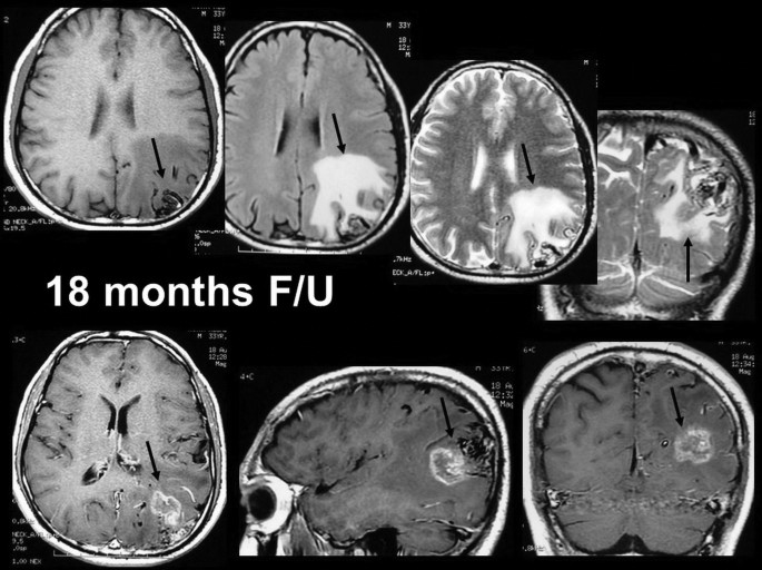 7-parts of M R I image of the brain after 18 months F slash U. An arrow points at the embolization. The scan includes top and sideways views.