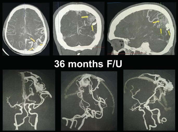 6-parts of brain image scans after 36 months F slash U. 3 arrows point to the embolization in the top 3 images. The bottom 3 images depict brain veins.