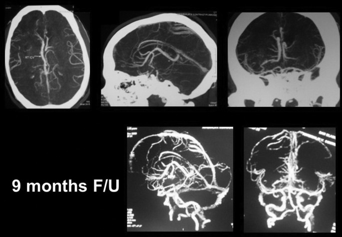 Five scans of a brain of 9 months follow up. The nerves in the brain are visible in each scan.