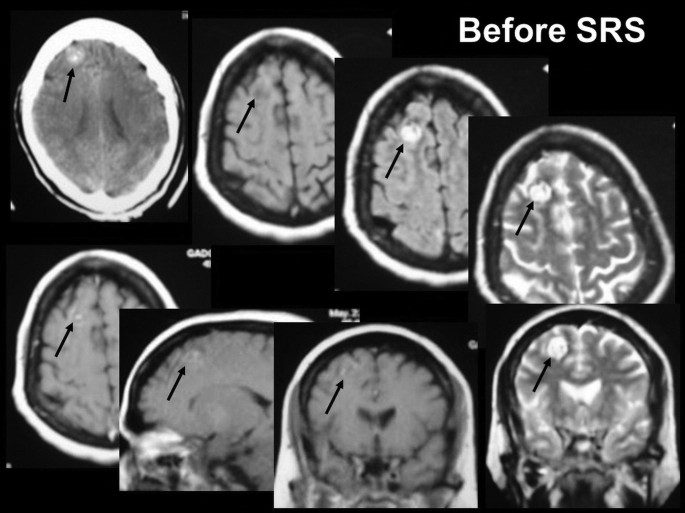 8 M R I scans of the human brain before S R S. The defective area of the brain is highlighted and marked by an arrow in each scan.