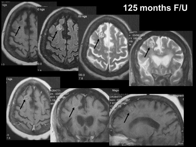 7 M R I scans of the human brain of 125 months follow up. The defective area in the brain is marked by an arrow.