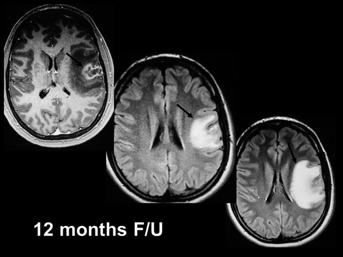 The three M R I scanned photographs represents the human brain at 12 months follow-up, and the defective area of the brain is highlighted and marked by an arrow.