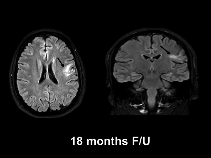 The two M R I scanned photographs represents the human brain at 18 months follow-up, and the defective area of the brain is highlighted and marked by an arrow.