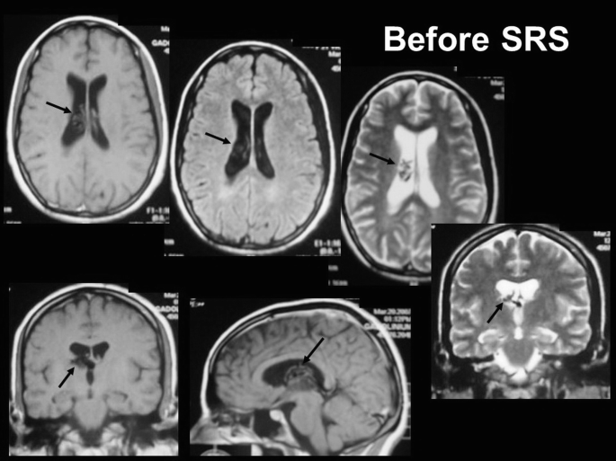 Six M R I scan images of a brain labeled before S R S. An arrow in each scan points to a tumor on the brain.