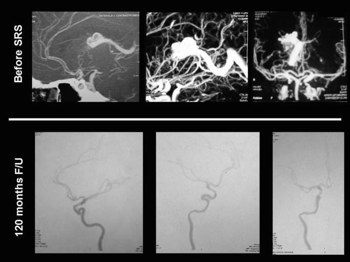 Six scanned images with smoky structures arranged in three columns and two rows. The two rows labeled before S R S and 120 months F forward slash U.