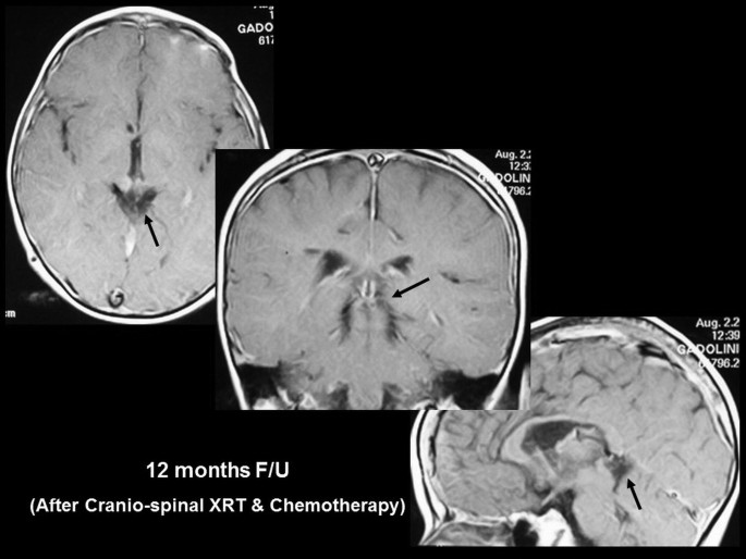 Pineal Parenchymal Tumor | SpringerLink