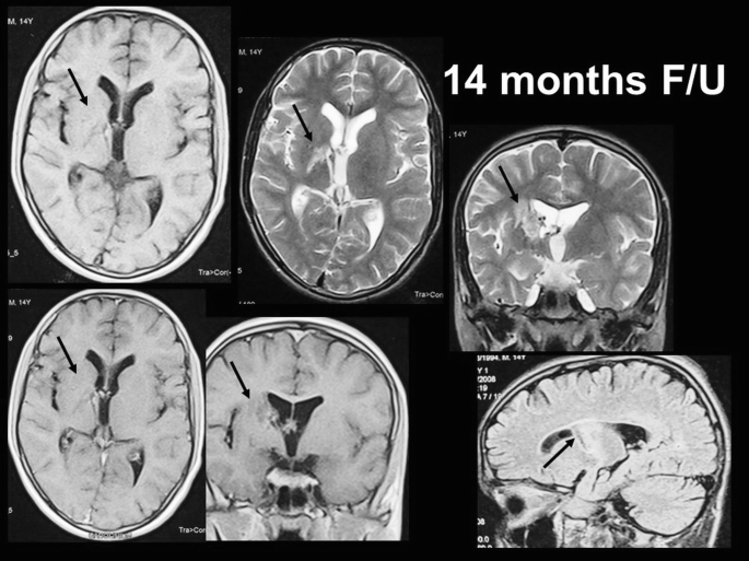 Six transverse C T scans represent the lateral C T scan of the cerebrum, confirming a region of A V M in the right cerebral hemisphere.