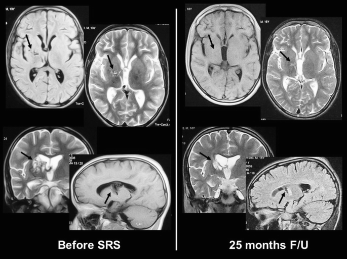 Eight C T scans, of which four before S R S are on the left and four 25 months F U stage are on the right.