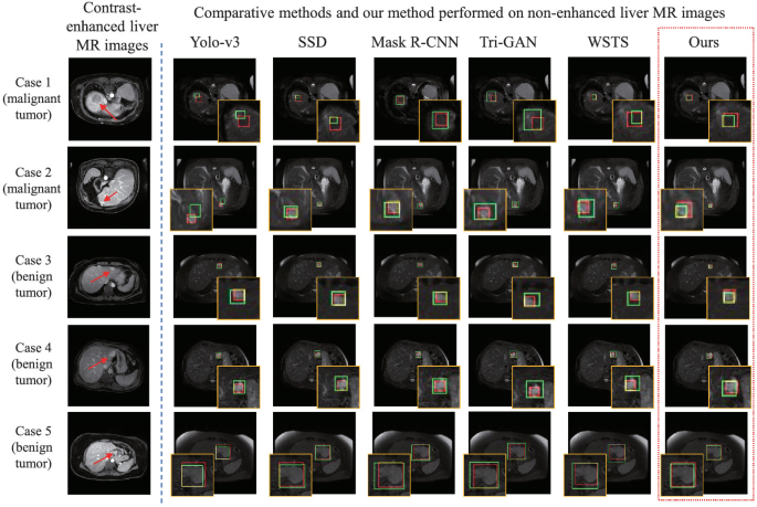 Leveraging Datature Nexus for Tumor and Anomaly Detection in Medical Scans  : Part I