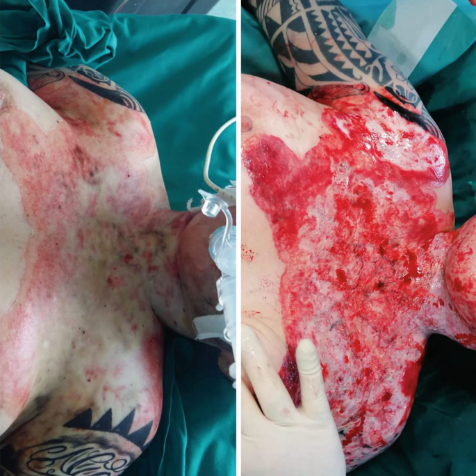 2 photographs. Photo 1 illustrates a person's neck and chest region with stained areas. Photo 2 displays the same person after the escharectomy procedure.