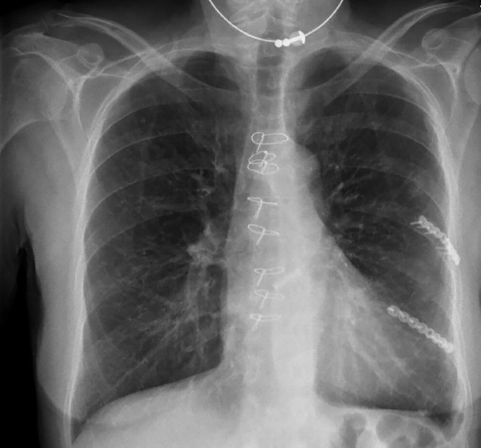 An X-ray of the chest reveals the dislocation of rib numbers 5 to 7 and a new pleural effusion.