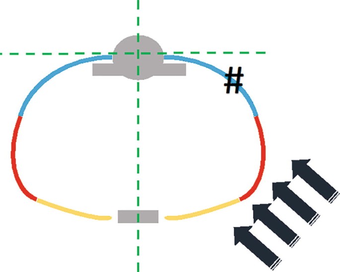 An illustration of the locations of the rib fracture. An arrow marks the entry of power from the right side.