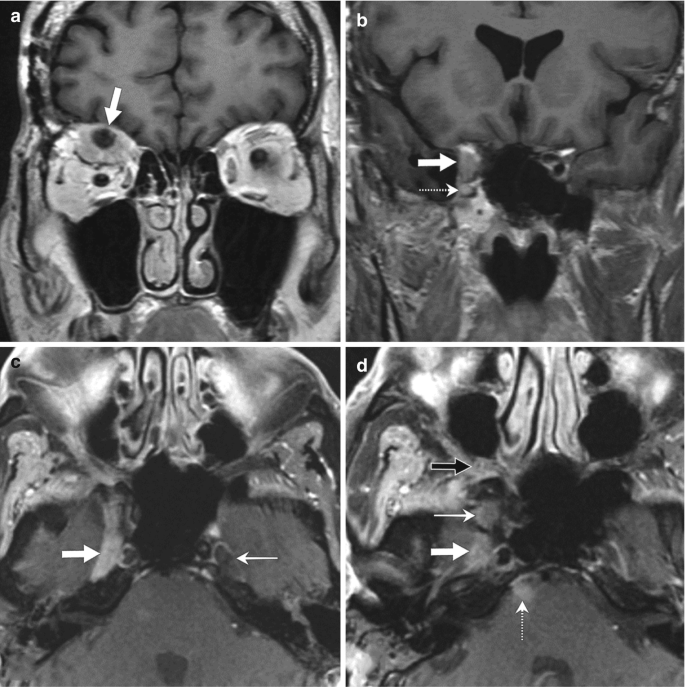 Four M R I images of a patient with squamous cell carcinoma of the skin are labeled (a) to (d). An arrow points to the ophthalmic division of the right trigeminal nerve in image (a), a thin arrow indicates the foramen rotundum in image (b), and another thin arrow points to the left Meckel&#x2019;s cave in image (c).