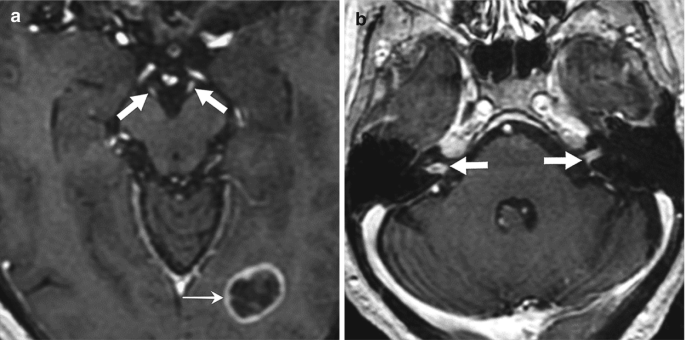 Two M R I images of a patient with breast cancer labeled (a) and (b). The arrows indicate the enhancement of oculomotor nerves from leptomeningeal tumor spread in image (a).