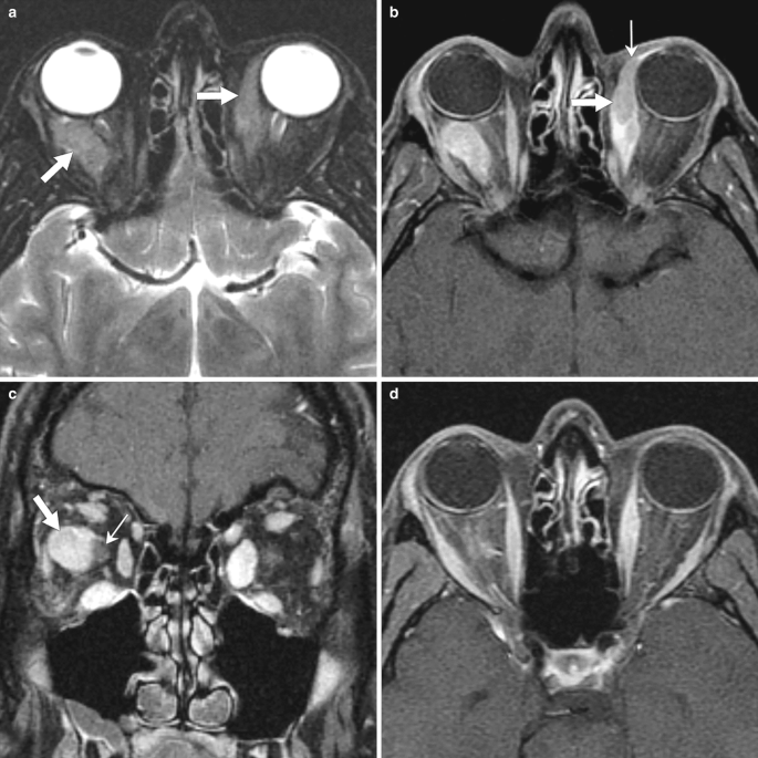 Four M R I images of a 35-year-old male with proptosis and periorbital edema because of idiopathic orbital inflammation labelled a to d.