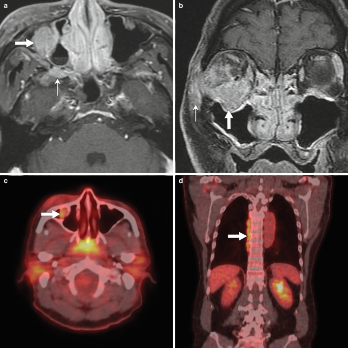 Two M R I images and two 18 F-F D G P E T, C T images of a 60-year-old male with lacrimal swelling in the right eye because of I g G 4-R D labelled a to d.