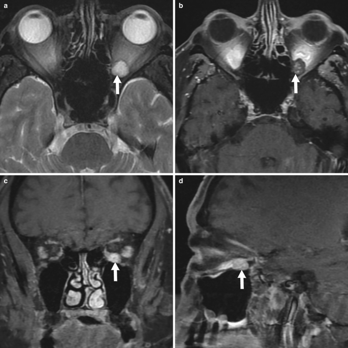 Four M R I images of a 72-year-old male with treated retroperitoneal liposarcoma but displayed incidental left orbital venous malformation labelled a to d.