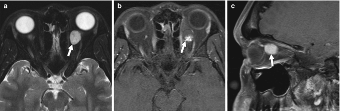 Three M R I images of a 46-year-old male experiencing headaches and exhibiting left orbital venous malformation labelled a to c.