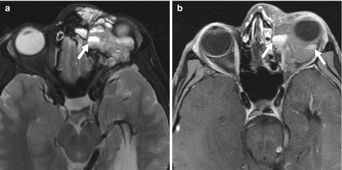 Two M R I images of a 19-year-old male with increasing proptosis related to a left orbital venolymphatic malformation labelled a and b.