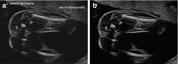 Two ultrasounds of the femur are labeled a and b. In scan A, the greater trochanter and end of ossified shaft are marked.