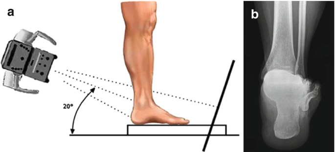 Image a is an illustration of the measurement of the human hindfoot by radiography. The angle between the foot and the ground is 20 degrees. Image b is an x-ray scan of the hindfoot.