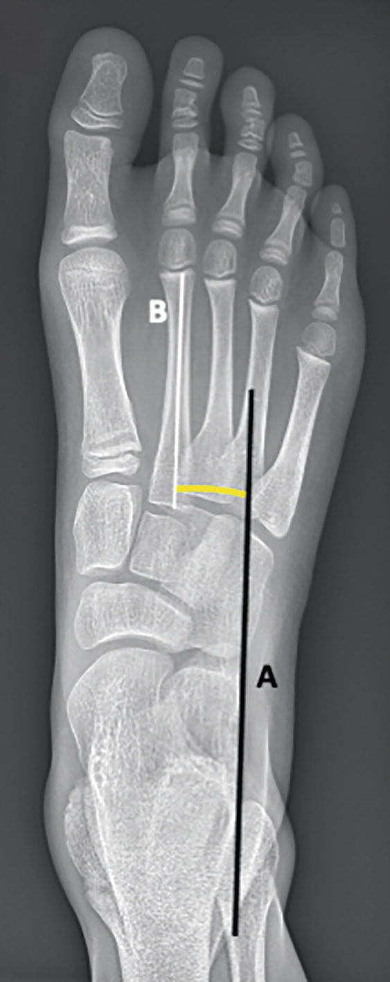 An x-ray scan of the A P view of the right human foot. Lines a and b make an angle in between the midcalcaneal line and the axis of the second metatarsal.