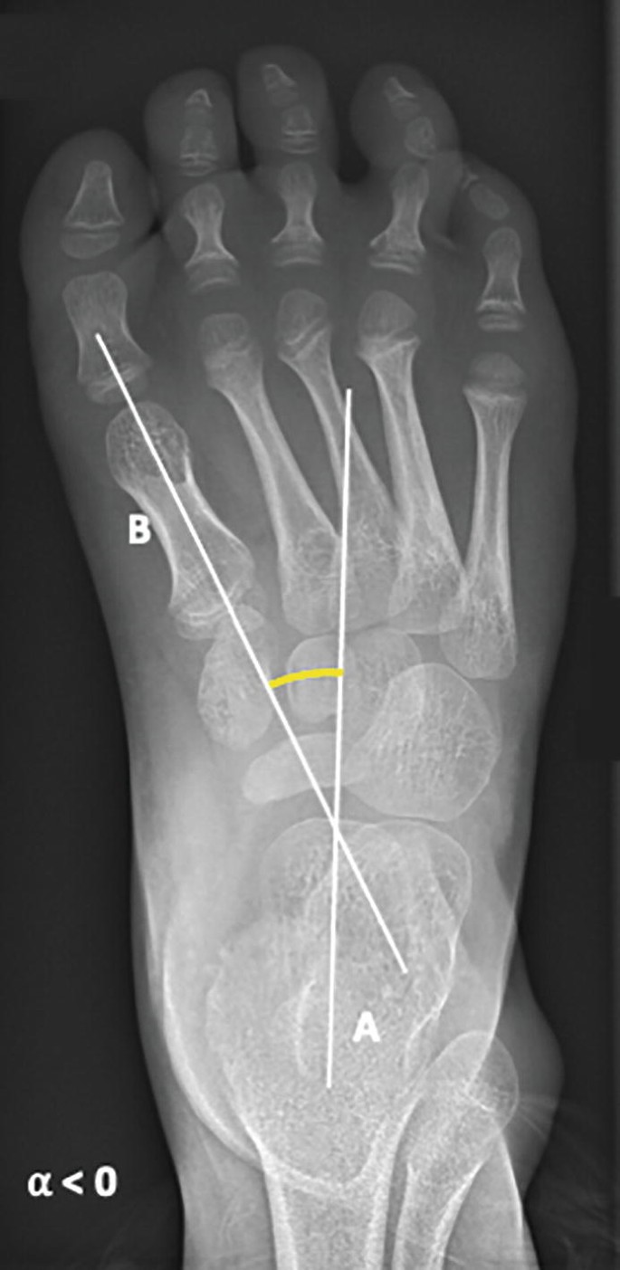 An x-ray scan of the dorsal view of the left human foot. Lines a and b make an angle between the midtalar line and the axis of the first metatarsal.