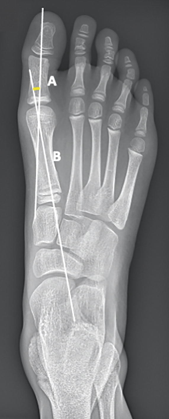 An x-ray scan of the A P view of the right human foot. Lines a and b make an angle between the proximal phalanx axis and the axis of the first metatarsal.