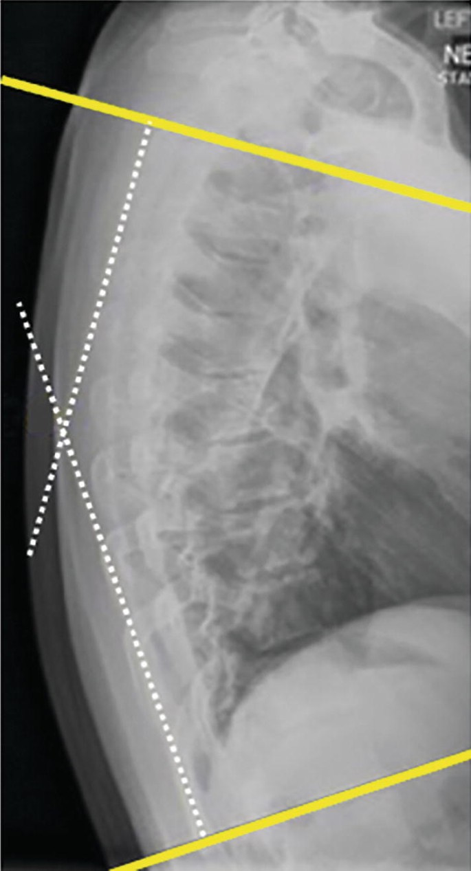 An X-ray image demonstrates a modified Cobb angle measurement.