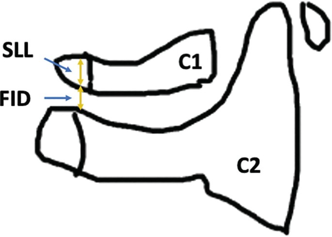 A diagram illustrates the spinolaminar line with C 1 and the flexion interspinous distance with C 2.