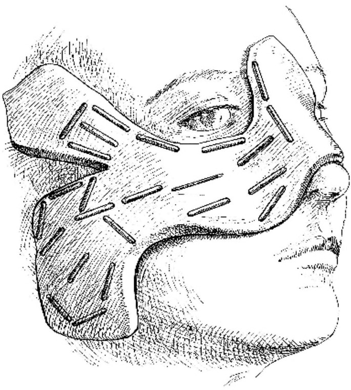 A sketch of radium needles on a mask layered over a person's nose, upper cheeks, and the side of the face.