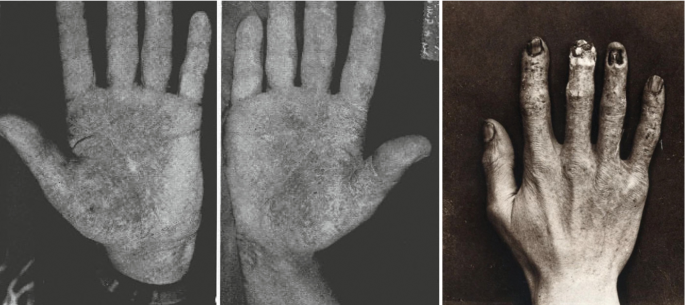 Three photographs of darkened and dry patches on the hands and rotting fingernails.
