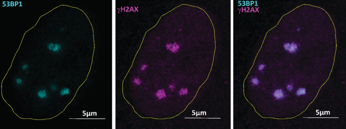 Three micrographs with two fluorescent dyes depict the presence of 53 B P 1, gamma H 2 A X, and 53 B P 1 plus gamma H 2 A X, respectively, at 5-micrometer scales.