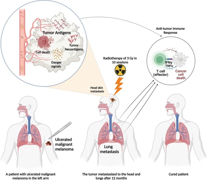 A diagram of a patient with the tumor metastasized to the head and lungs after 12 months display inset images of tumor antigens, cell death, tumor neoantigens, and danger signals that forwards to an anti-tumor immune response.