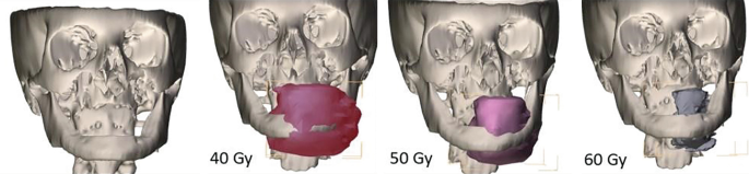 Four three-dimensional images of the removal of high-risk teeth in I R exposed bone in 40 grey, 50 grey, and 60 grey.