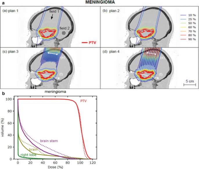 4 treatment plans for meningioma. Plans 1 and 2 are homogeneous plans while 3 and 4 display single field p M B R T plans that directly target P T V in the brain. Below, a line graph of volume versus dose. Right lobe, brain, and brain stem depict a downward trend while P T V plateau before declining.