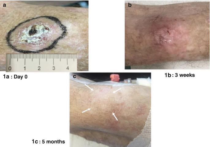 3 photos of a treated lesion. A displays day 0 where P T V delineated limits around the lesion at 4 inches in diameter. B is the lesion after 3 weeks, which presents the lesion healing and decreasing in diameter. C is the lesion after 5 months where 4 arrows denote the fully healed lesion on the skin.